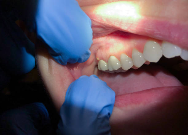 Best Broken or Cracked Tooth Emergency Dentist in Avenel, NJ
